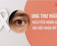 UNG THƯ MẮT: NGUYÊN NHÂN VÀ DẤU HIỆU NHẬN BIẾT